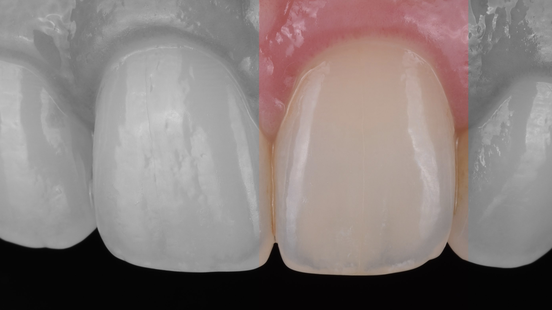 Value and translucency study – single tooth
