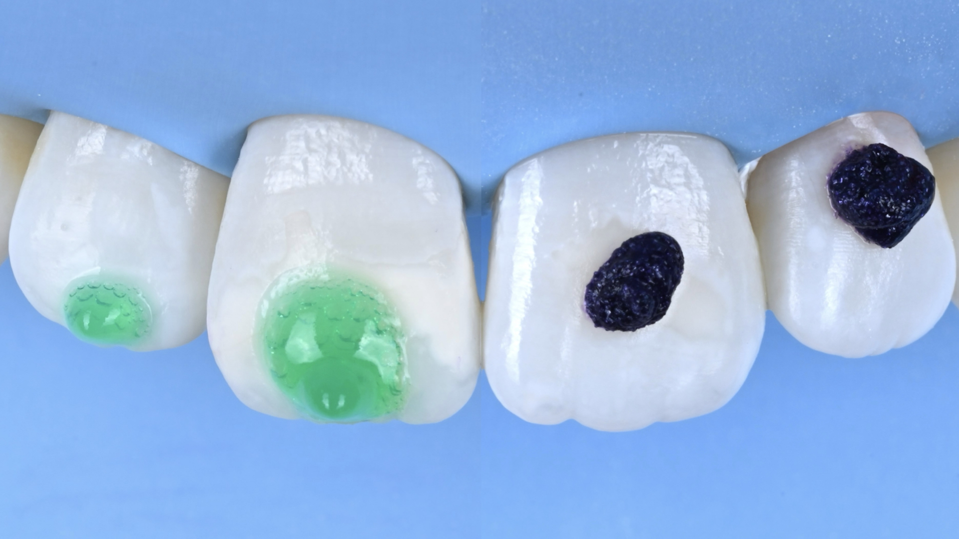 Etching and resin infiltration step