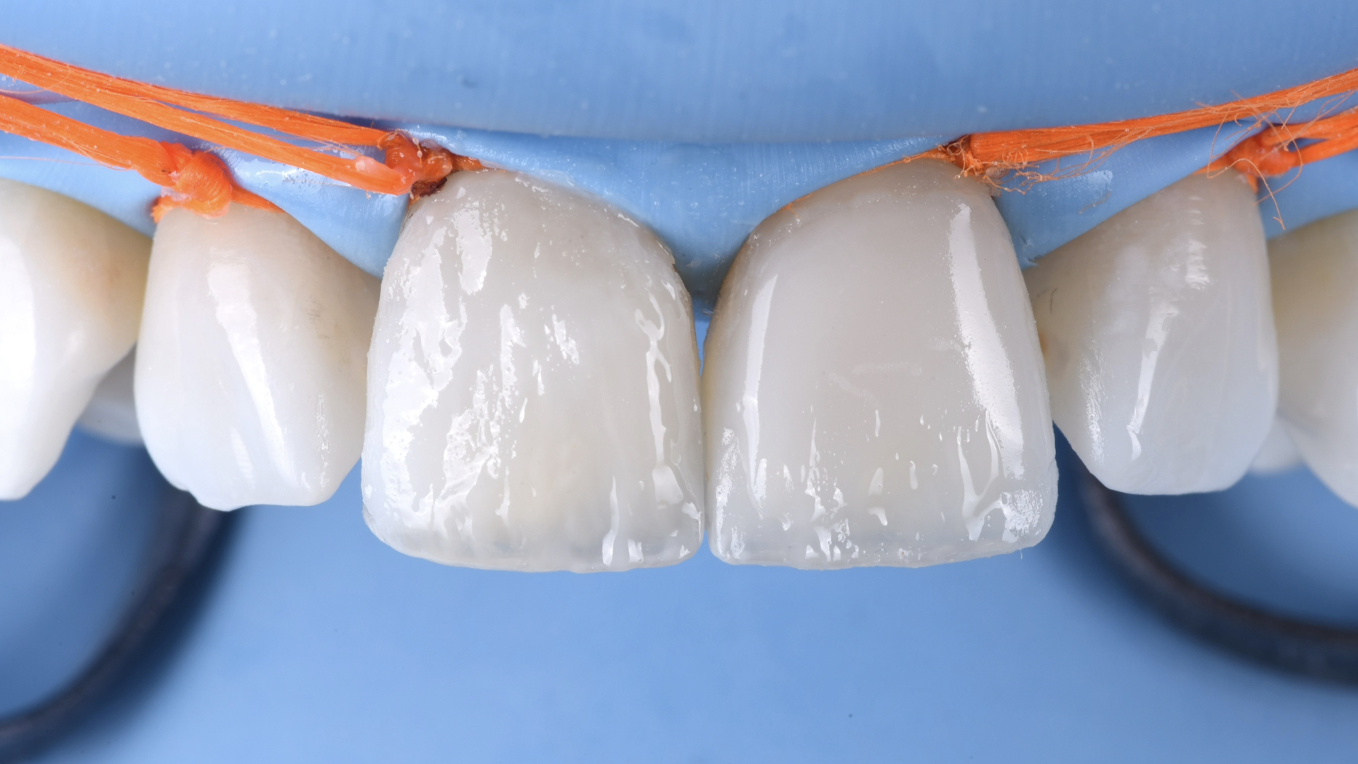 Anterior restorations under rubber dam